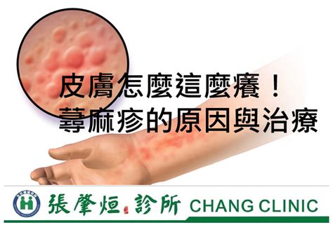 為什麼皮膚越抓越癢|皮膚癢7原因「不一定是皮膚病」！ 最有效止癢方法曝。